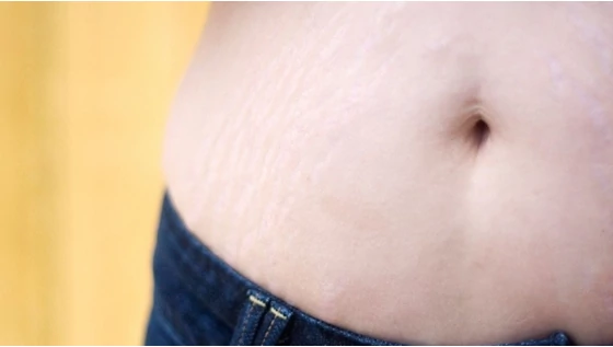 Szabadulj meg a striáktól természetesen